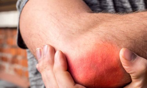 Entzündung im Ellenbogen